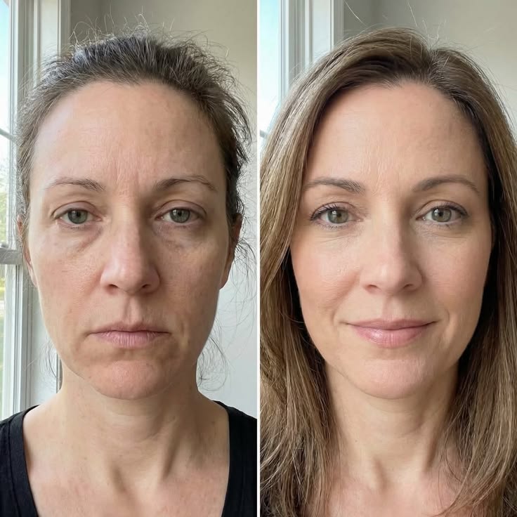 Antes e depois Lumielle 8