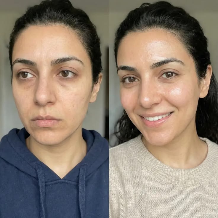 Antes e depois Lumielle 9