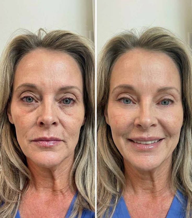 Antes e depois Lumielle 10