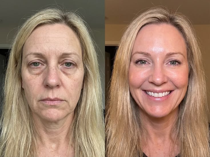 Antes e depois Lumielle 6