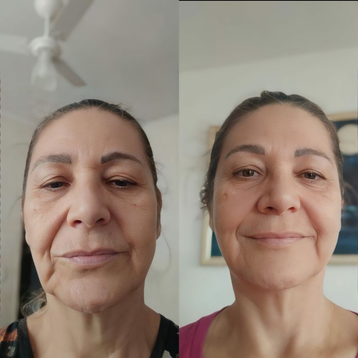 Antes e depois Lumielle 1
