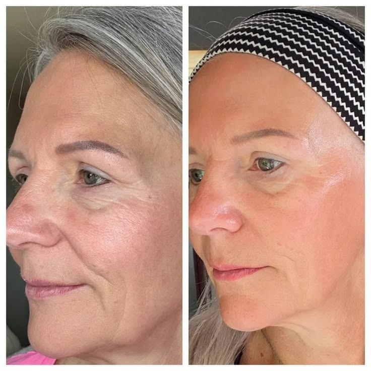 Antes e depois Lumielle 2